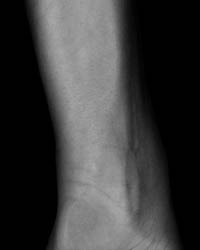 arm15